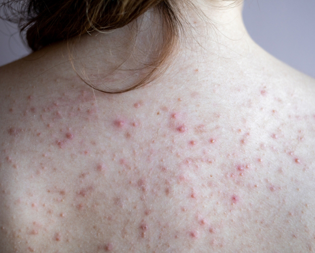 Điều Trị Mụn Lưng Tại Sen Beauty